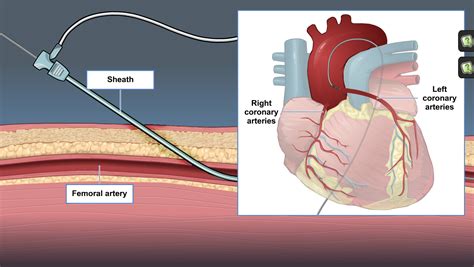 left heart catheterization cheat sheet.